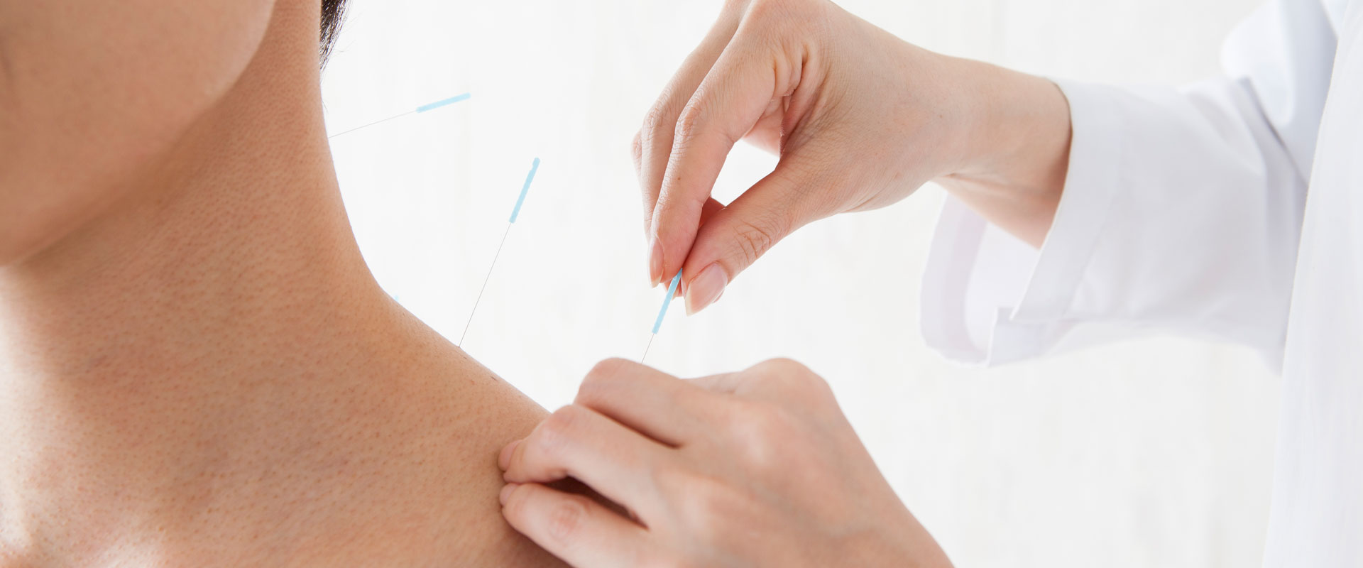 woman getting acupuncture 