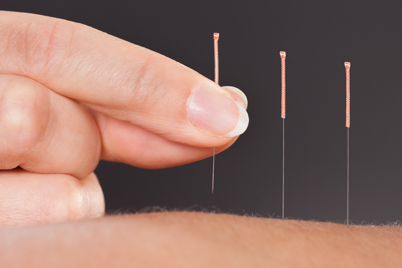 acupuncture Beverly Hills